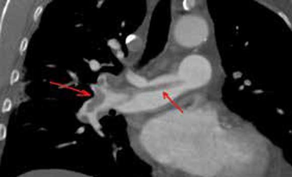 Arrows point to blood clots, shaded gray, in patient’s lung.