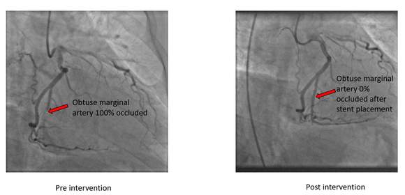 View of Steve Rovik’s artery, pre and post intervention comparisons