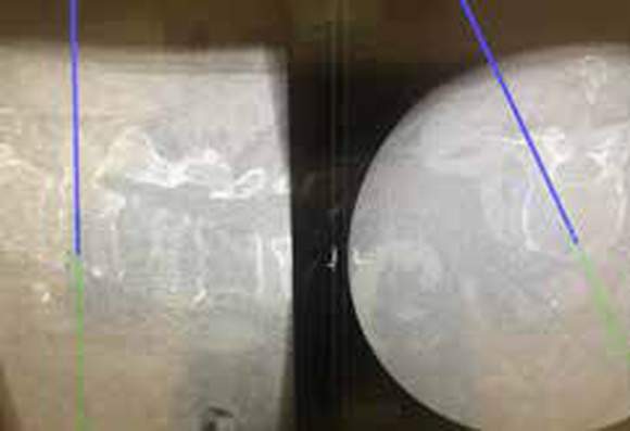 CT scan image of minimally-invasive lower back surgery using 3-D guidance system.