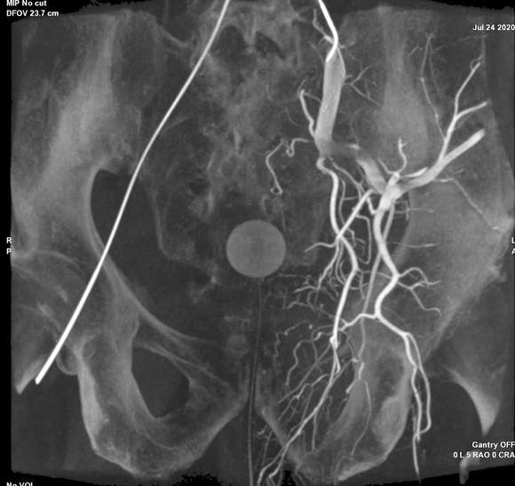 Intra-procedural 3 Dimensional CTAngiogram reconstruction image displaying blood vessels in a patient's pelvis.