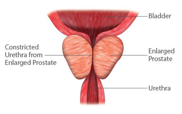 Blockage caused by BPH