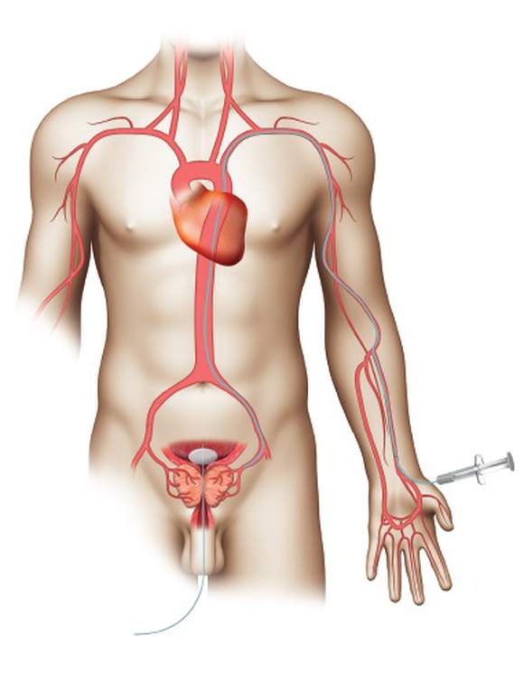 Catheter being inserted through a small incision on the wrist.