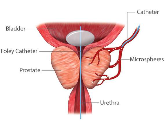 The catheter is now preventing the blockage from BPH.