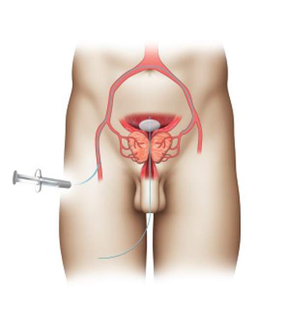 Catheter being inserted through a small incision on the thigh.