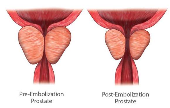 Prostate before and after treatment
