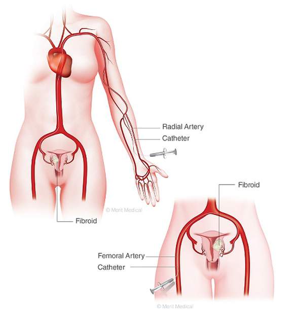 Catheter insertion