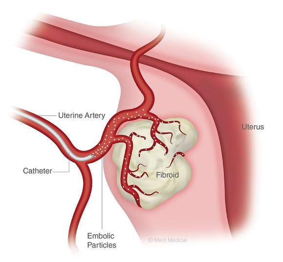 Microspheres being used to treat a fibroid.