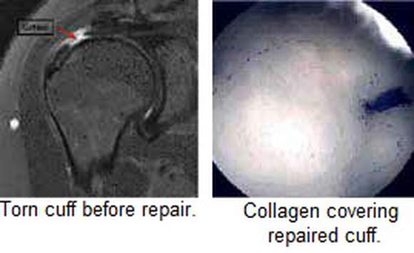Torn cuff before repair, Collagen covering repaired cuff.